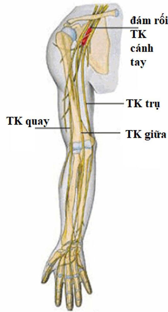 Learn about radial neuropathy