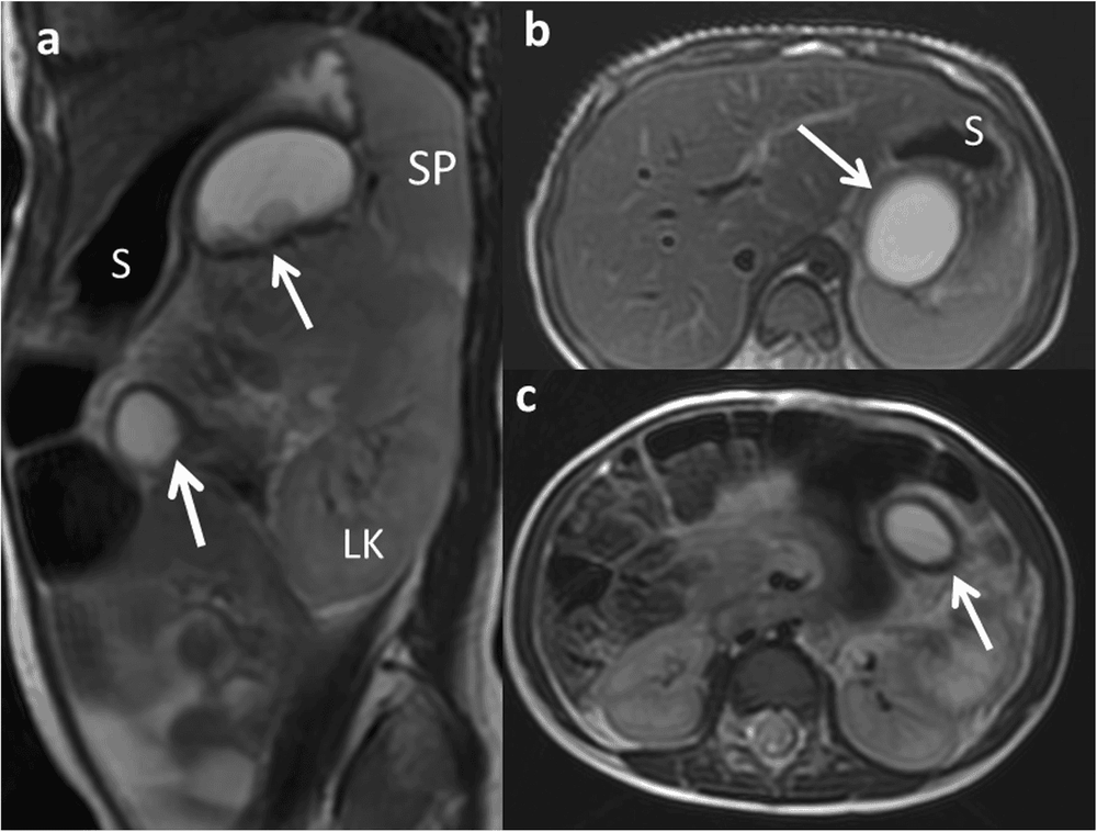 
Nang ruột đôi trên hình ảnh MRI
