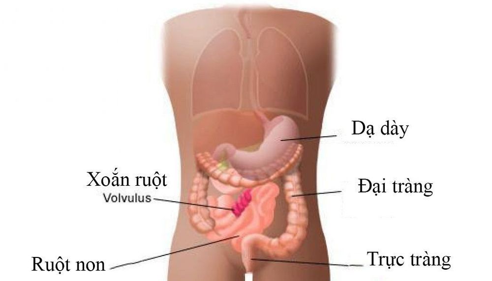 
Bệnh xoắn ruột (Volvulus)
