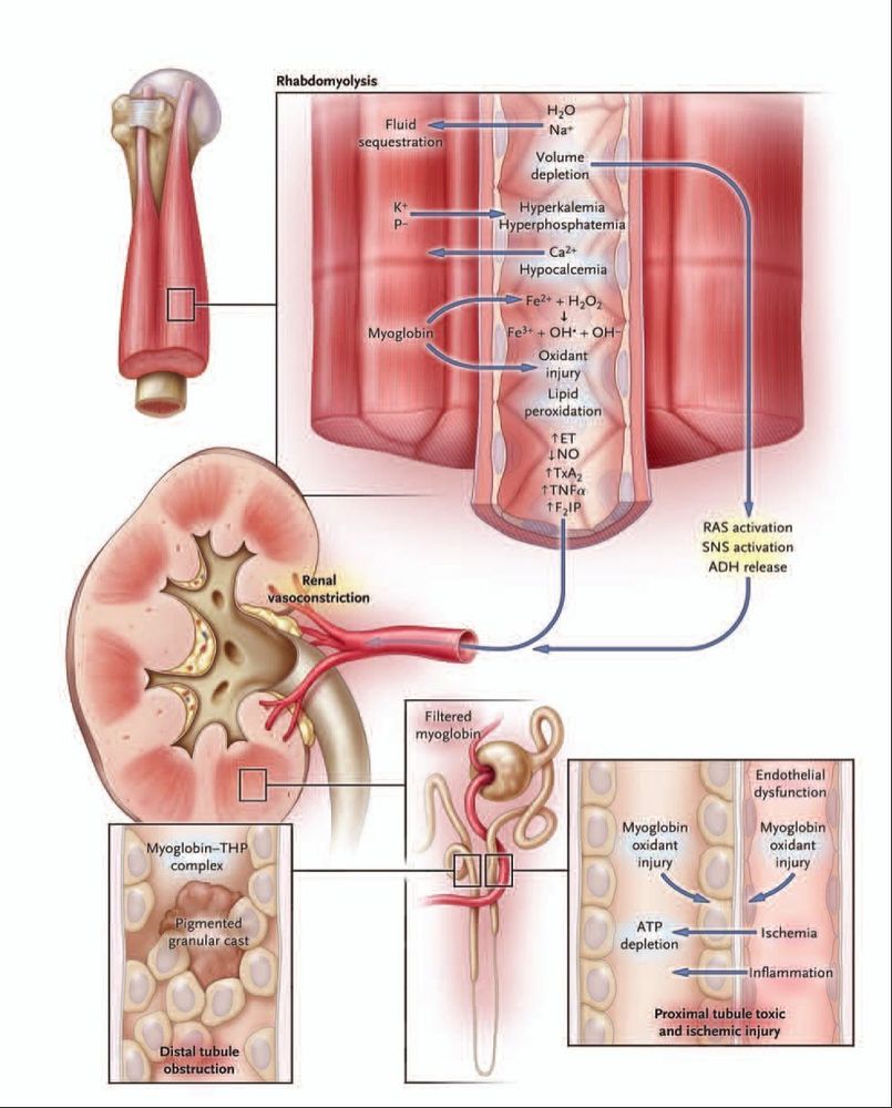 
Tiêu cơ vân do nhiễm toan ceton, rối loạn điện giải
