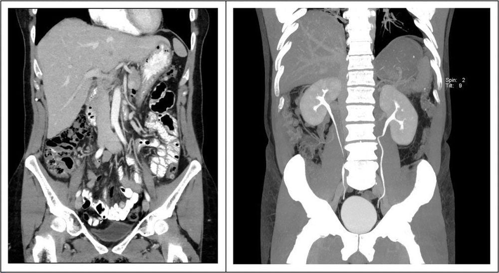 
Hình ảnh CT hệ tiết niệu
