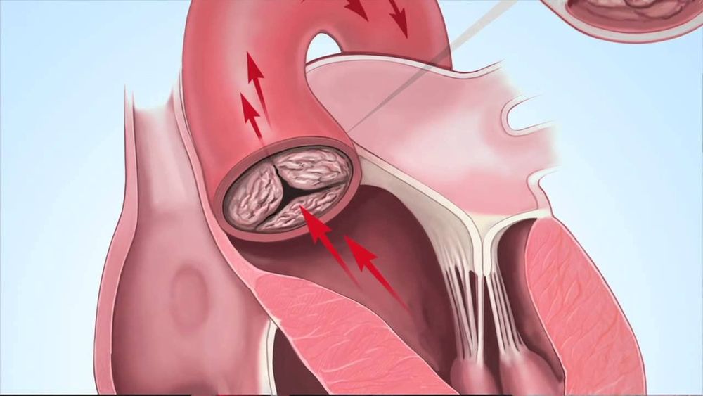 
Người có bệnh lý van tim cần được siêu âm tim định kỳ
