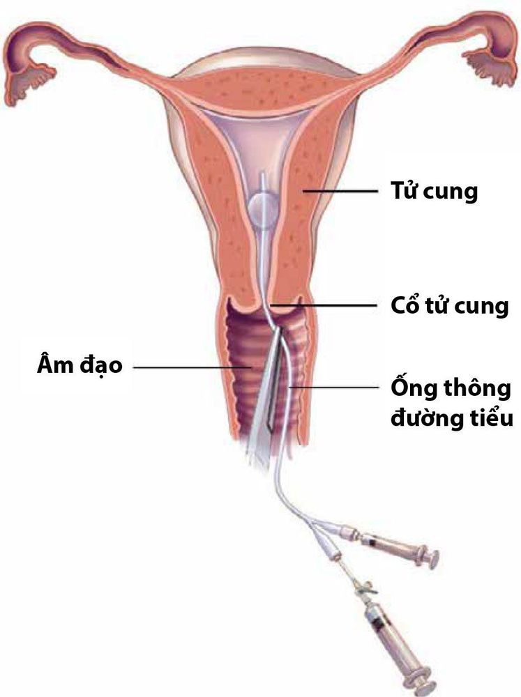 
Thực hiện kỹ thuật chụp tử cung - vòi tử cung
