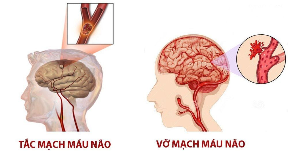 
Tình trạng mạch máu não bị tổn thương
