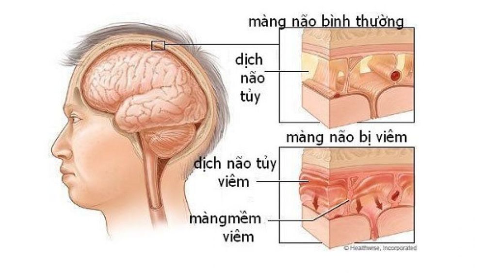 
Biến chứng bệnh viêm màng não gây tụ mủ dưới màng cứng
