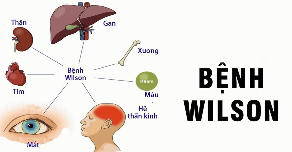 
Bệnh lý Wilson tác động đến gan
