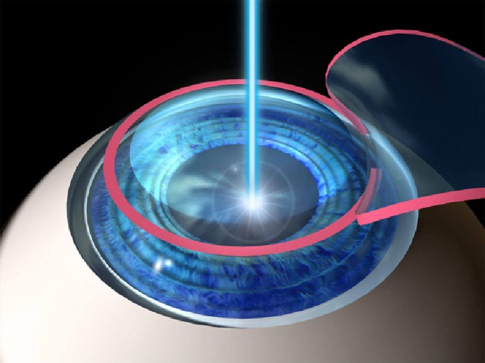 
Phương pháp phẫu thuật cận thị bằng LASIK hiện đang rất phổ biến
