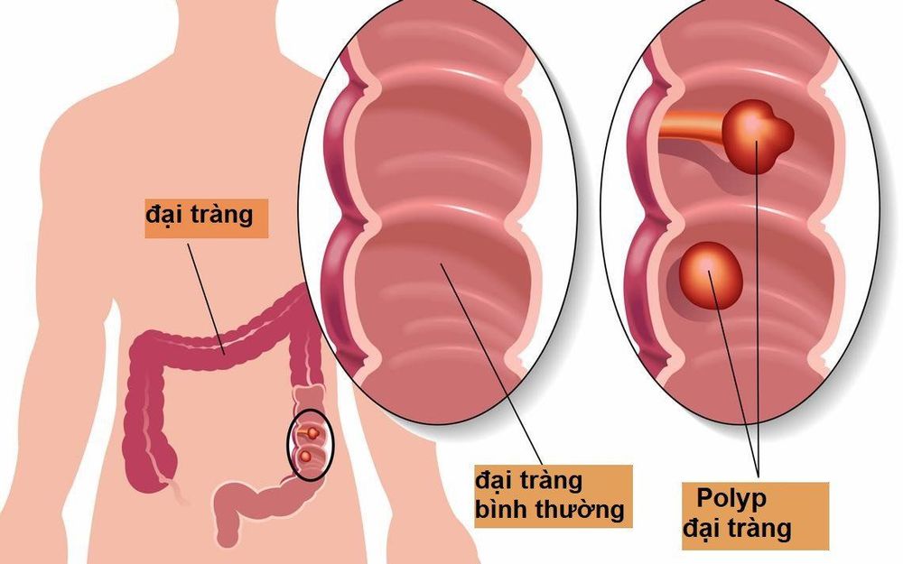 
Polyp đại tràng là một khối nhỏ các tế bào hình thành trên niêm mạc đại tràng
