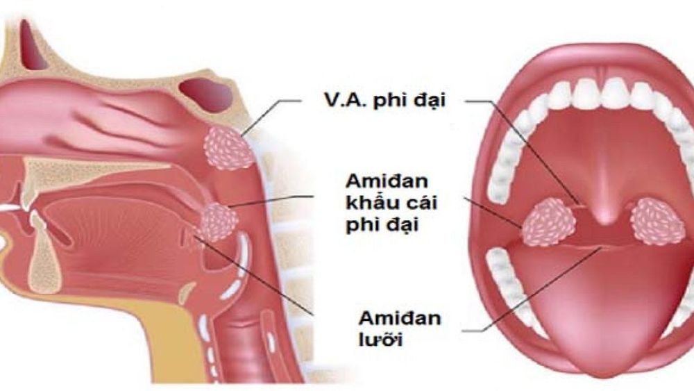 
VA là một bộ phận của hệ bạch huyết có chức năng bảo vệ đường hô hấp
