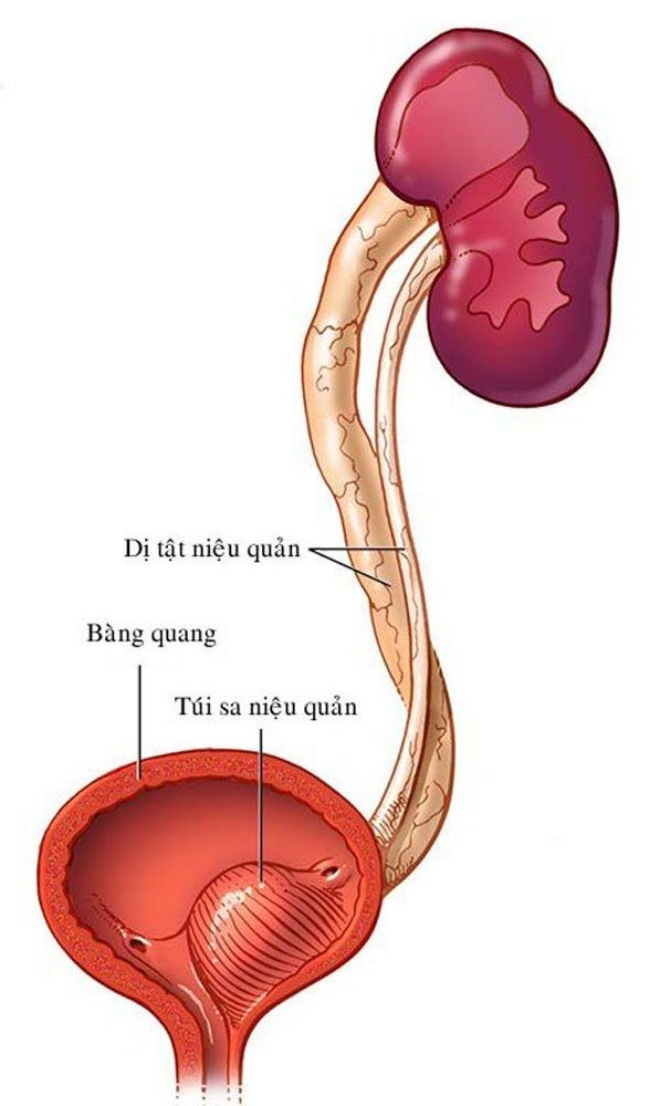 
Vị trí túi sa niệu quản
