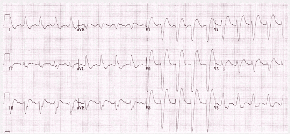 
Điện tâm đồ biểu thị tình trạng QRS Block nhánh trái
