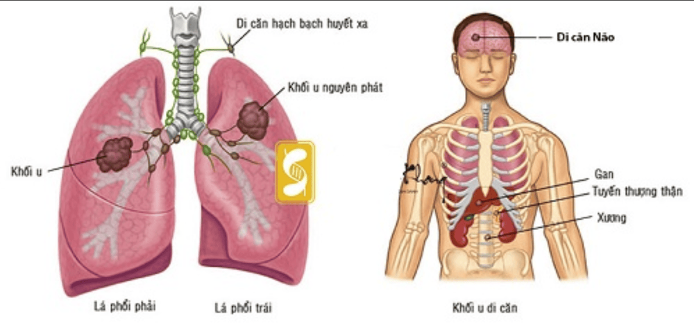 
Giai đoạn 4 của ung thư phổi, tế bào ung thư di căn đến cơ quan khác trong cơ thể người bệnh
