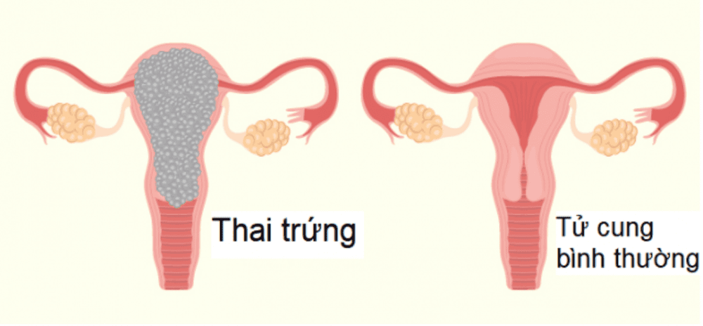 
Thai trứng là tình trạng nhau thai phát triển không bình thường.
