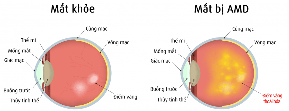 
Thoái hóa điểm vàng là một trong những bệnh thoái hóa võng mạc
