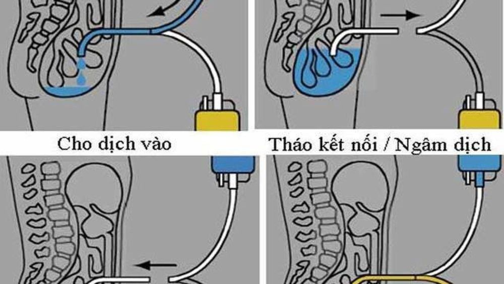 
Phương pháp lọc màng bụng liên tục ngoại trú đơn giản và phù hợp với các bệnh nhân có điều kiện kinh tế thấp
