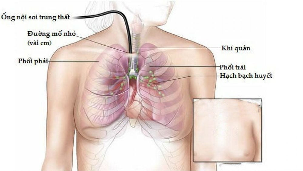 
Phẫu thuật nội soi lồng ngực được ứng dụng trong sinh thiết khối u hạch tại trung thất
