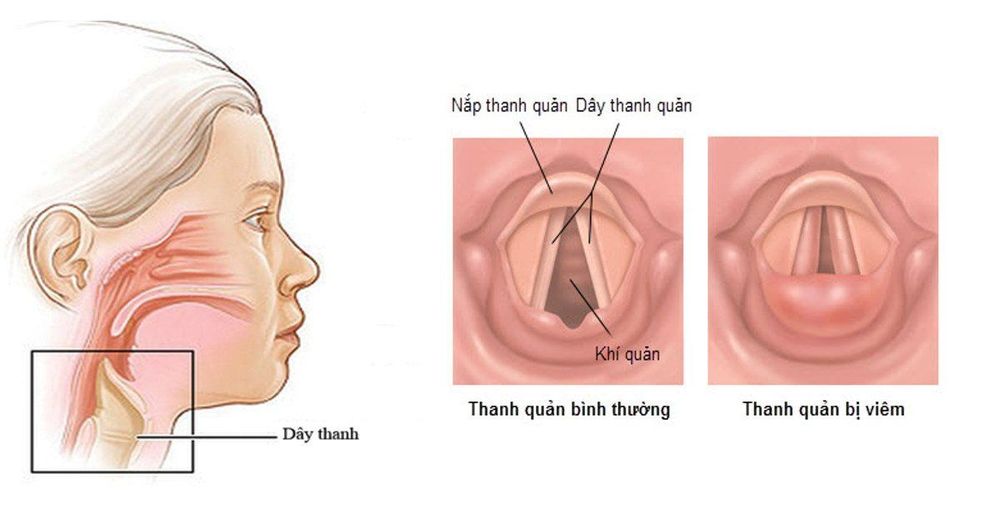 
Viêm thanh quản là một trong những biến chứng có thể xảy ra sau khi thực hiện kỹ thuật đặt ống nội khí quản qua đường miệng
