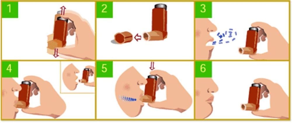 Thuốc xịt hít trong kiểm soát hen phế quản