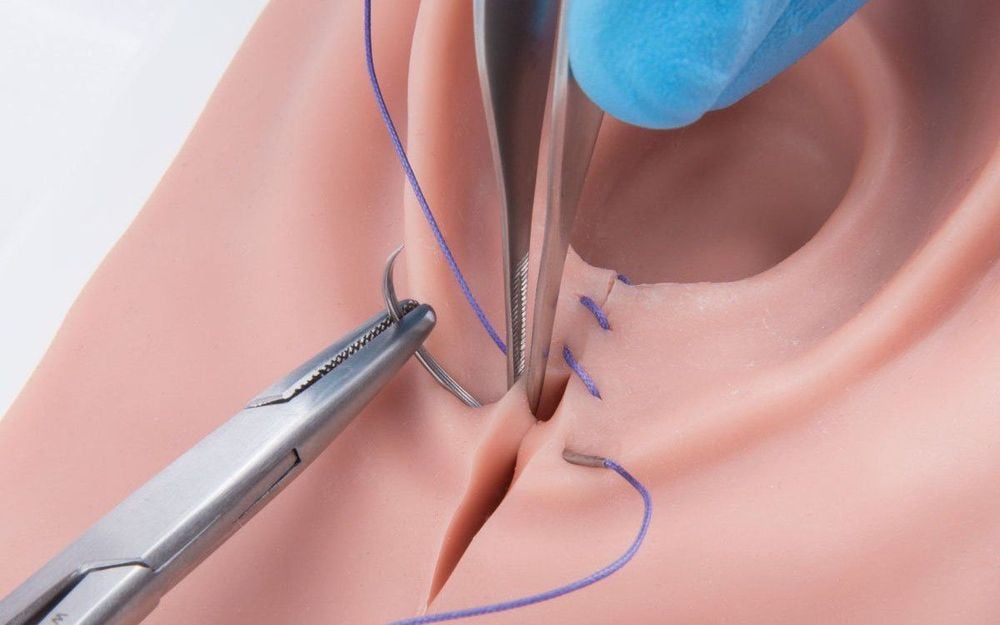 
Pain and swelling at the perineal suture is one of the causes of postpartum urinary retention
