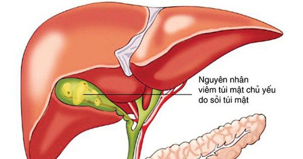 
Viêm túi mật có thể dẫn đến nhiều biến chứng nguy hiểm nếu không được can thiệp điều trị kịp thời
