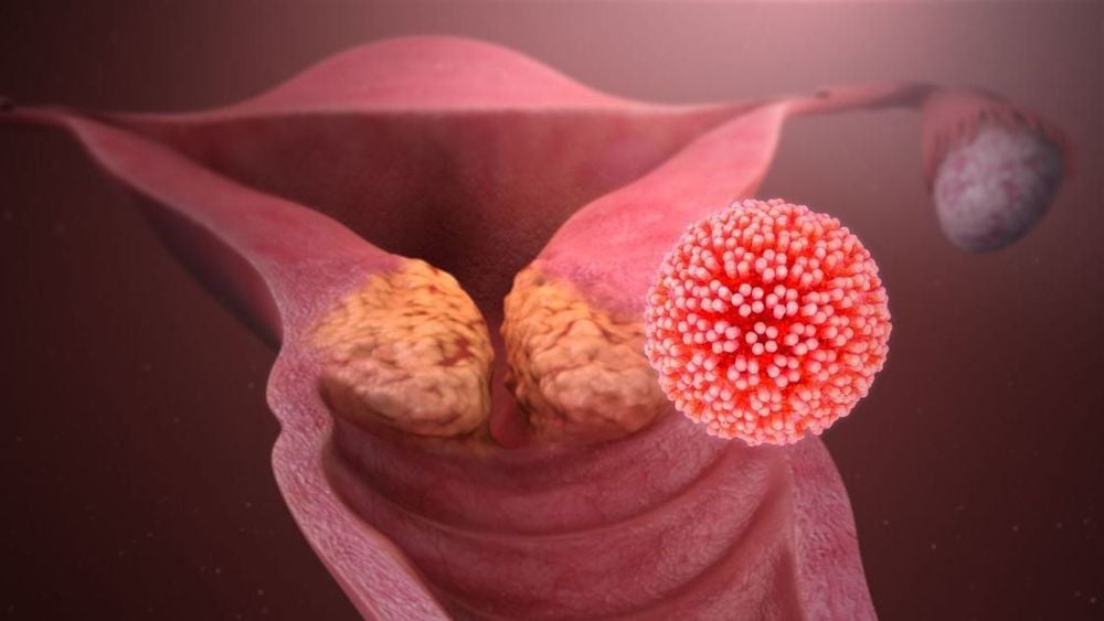 
Virus HPV là nguyên nhân chính gây ra ung thư cổ tử cung ở nữ giới
