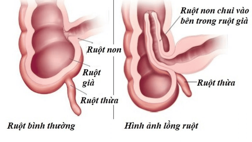 
Điều trị lồng ruột ở trẻ nên được tiến hành càng sớm càng tốt, tránh các biến chứng
