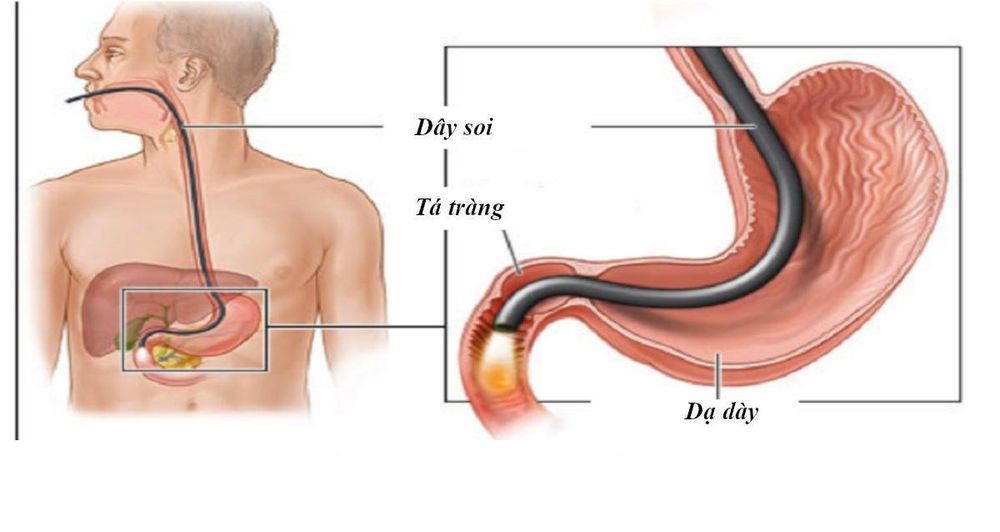 
Nội soi dạ dày kiểm tra mức độ nặng hay nhẹ
