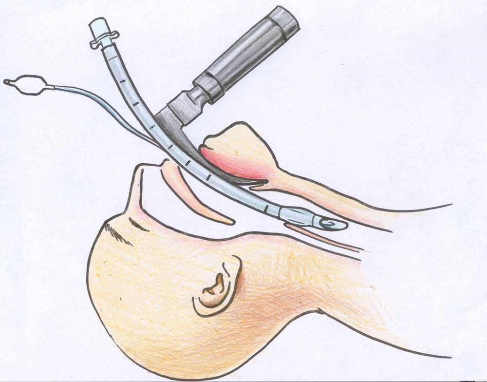 
Đặt ống nội khí quản qua miệng của bệnh nhân
