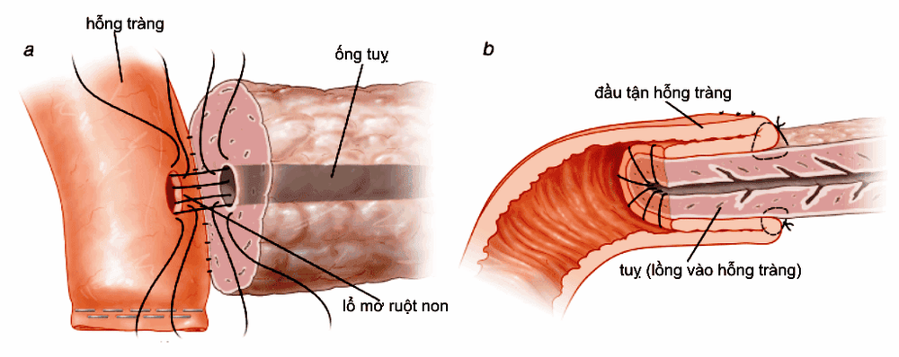 
Mô phỏng kỹ thuật nối ruột tụy ngoại khoa
