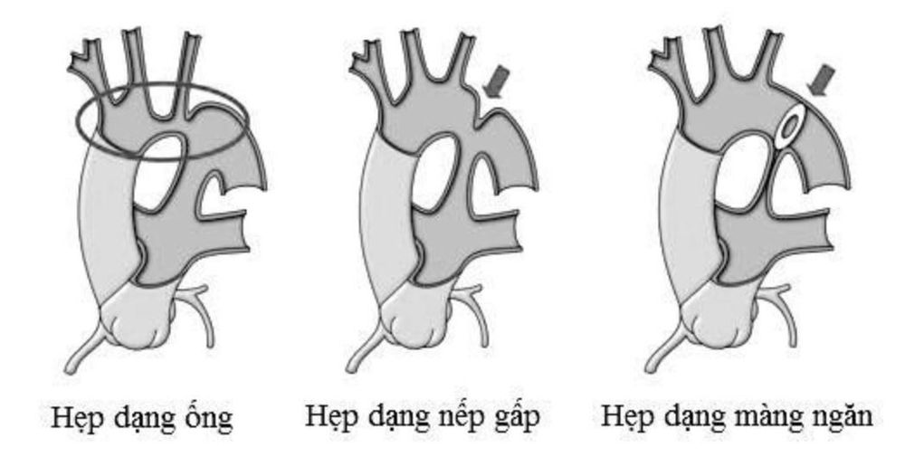 
Các dạng hẹp eo động mạch chủ
