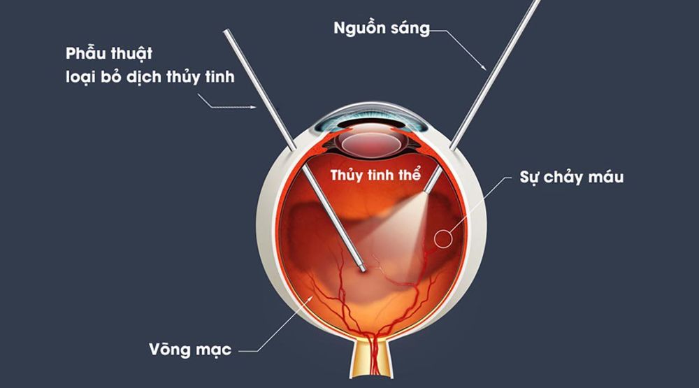 
Hình ảnh mô tả phương pháp sử dụng tia laser loại bỏ vẩn đục dịch kính
