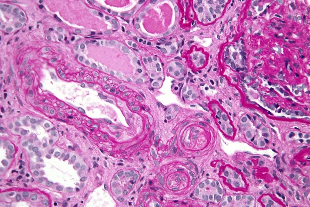 
Hội chứng kháng phospholipid có thể làm tăng nguy cơ sảy thai nhiều lần
