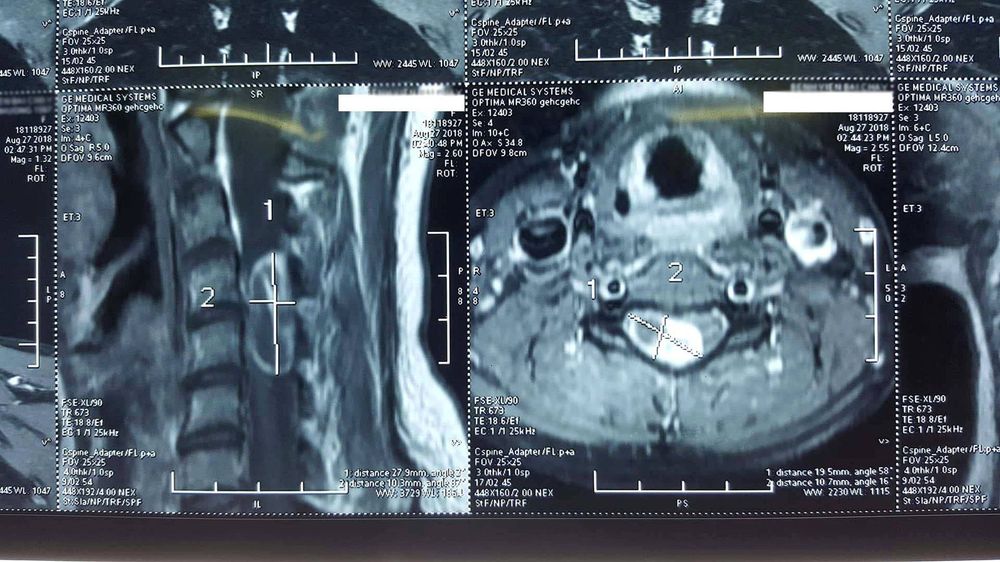 
Hình ảnh chụp Cộng hưởng từ (MRI) đột sống cổ trên bệnh nhân có khối u tủy cổ
