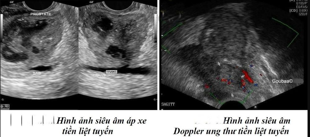 
Hình ảnh siêu âm vùng chậu cho thấy tuyến tiền liệt có bệnh lý bất thường
