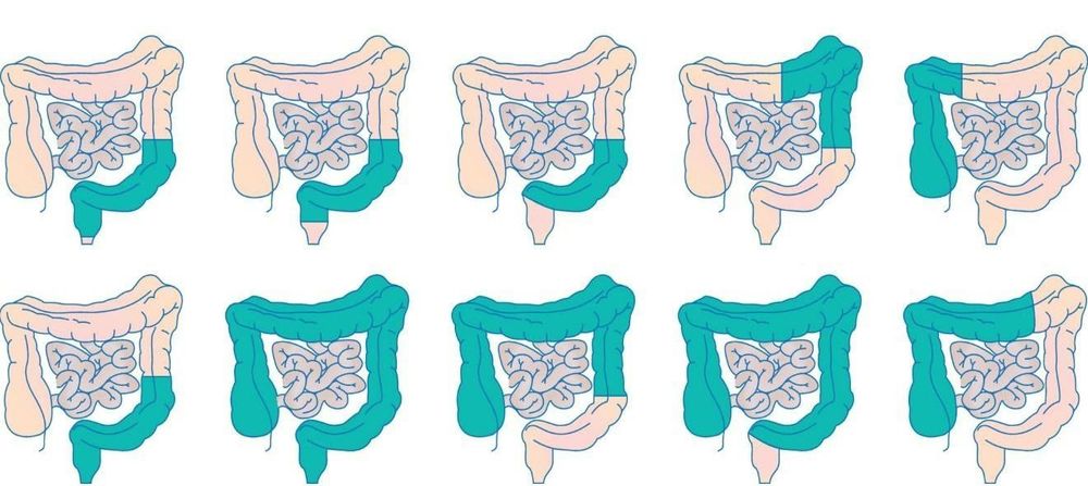 Dysfunction after colectomy - rectum