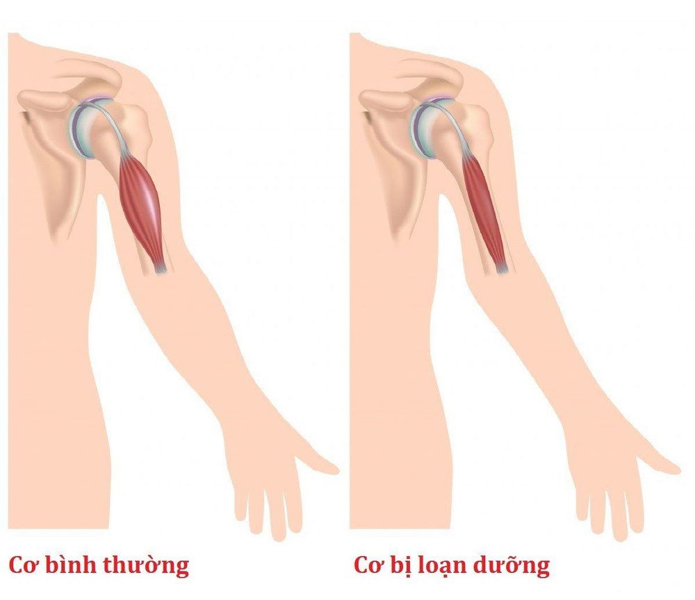 
Loạn dưỡng cơ là bệnh di truyền, khiến tình trạng cơ bị teo dần
