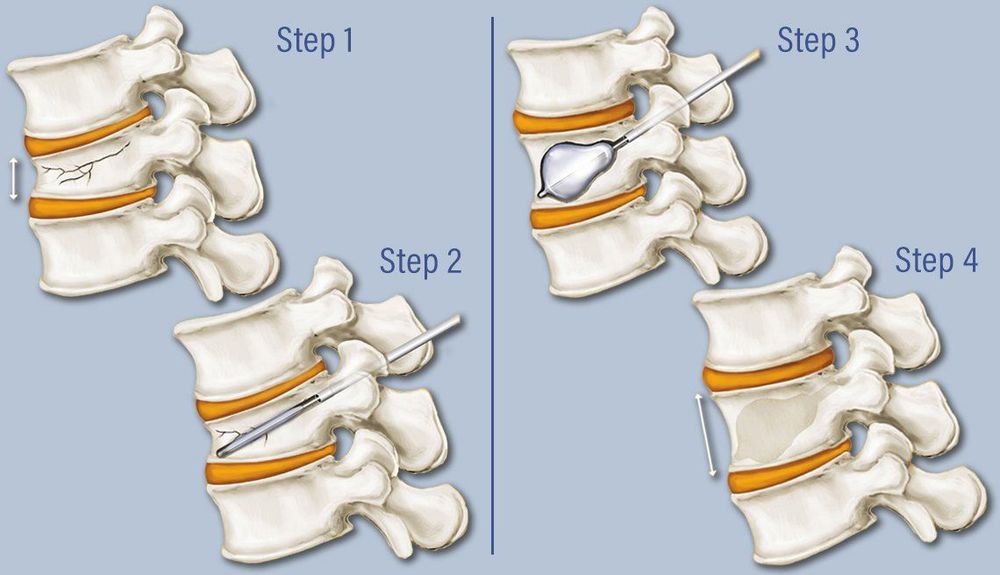 
Phẫu thuật tạo hình cột sống
