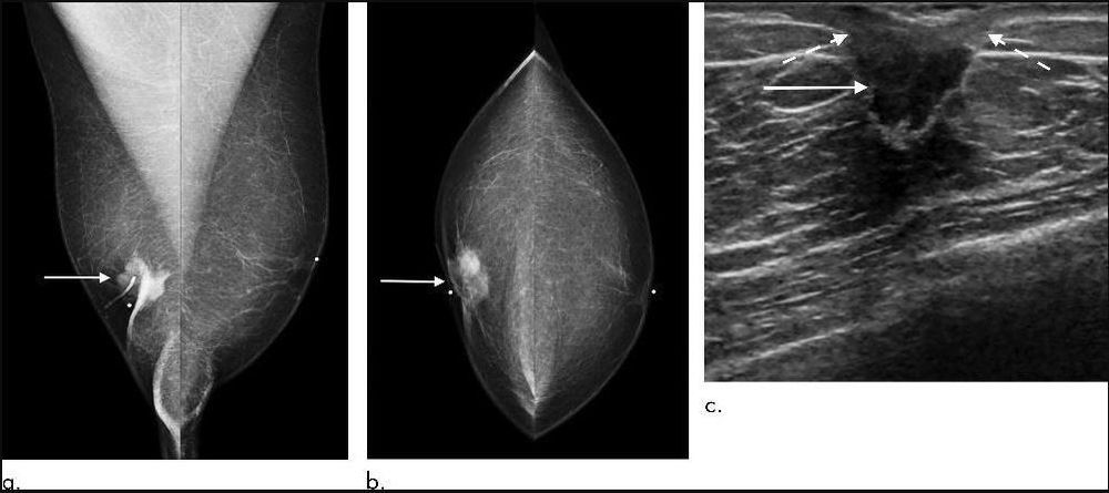 
Hình 2. Hình nhũ ảnh của một người đàn ông 74 tuổi, được thực hiện để chẩn đoán khối sờ thấy được ở vú phải. (a, b) Nhũ ảnh tư thế chếch cho thấy khối dưới núm vú phải kèm theo sự co rút của núm vú. (c). Siêu âm thấy khối tương ứng, bờ không đều, xâm lấn trực tiếp vào núm vú gây co kéo núm vú.
