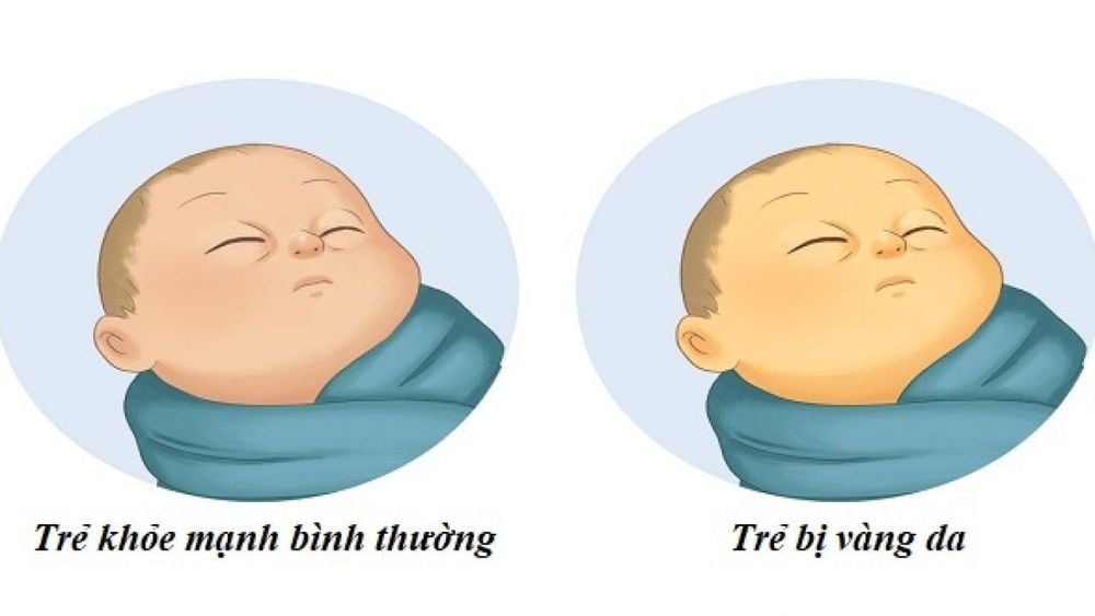 
Khi bilirubin tăng vượt quá giới hạn bình thường trong máu, trẻ sơ sinh sẽ bị nhuốm màu vàng ở da và kết mạc mắt
