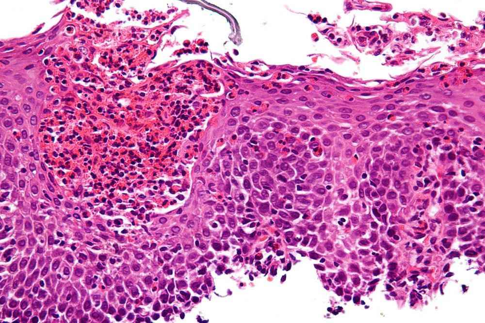 
Bạch cầu ái toan Eosinophils là một trong những thành phần của bạch cầu được sản sinh từ tủy xương và là một trong những tế bào có vai trò thúc đẩy tiến trình viêm
