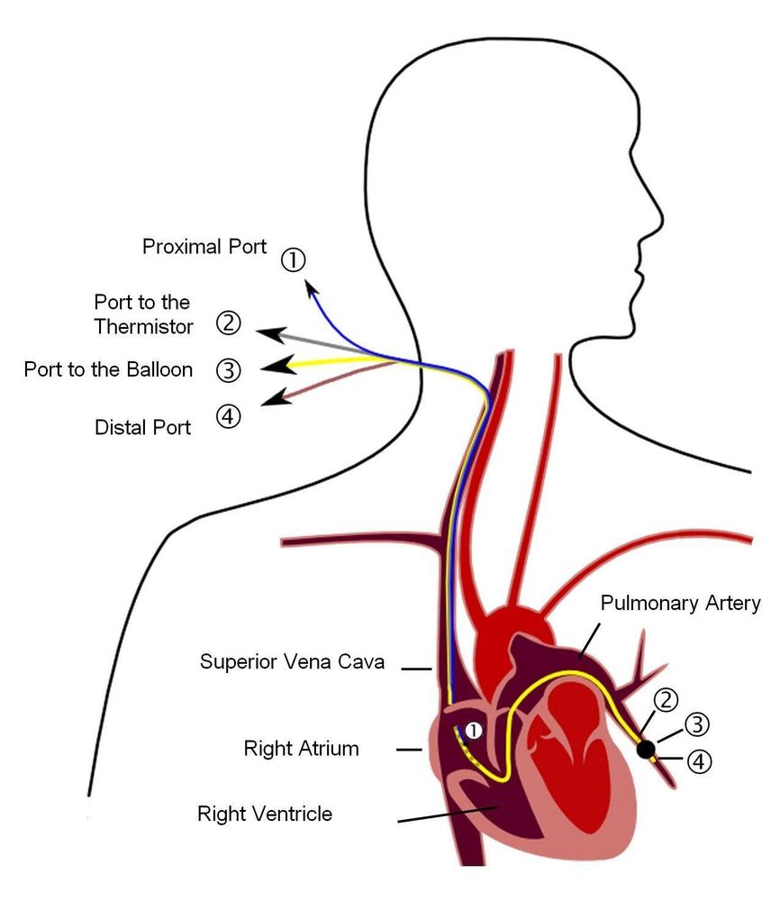 
Hình 1: Phương pháp đặt PAC hay còn gọi là Swan---Ganz catheter Một catheter(màu vàng) được đặt vào động mạch phổi, có Sensor nhiệt tại đầu tận(4) có vai trò đo nhiệt độ của dòng nước lạnh được bơm vào tại vị trí số 1. Nếu tốc độ dòng nhiệt lạnh đến số 4 càng nhanh tức là tim bóp càng tốt và ngược lại.
