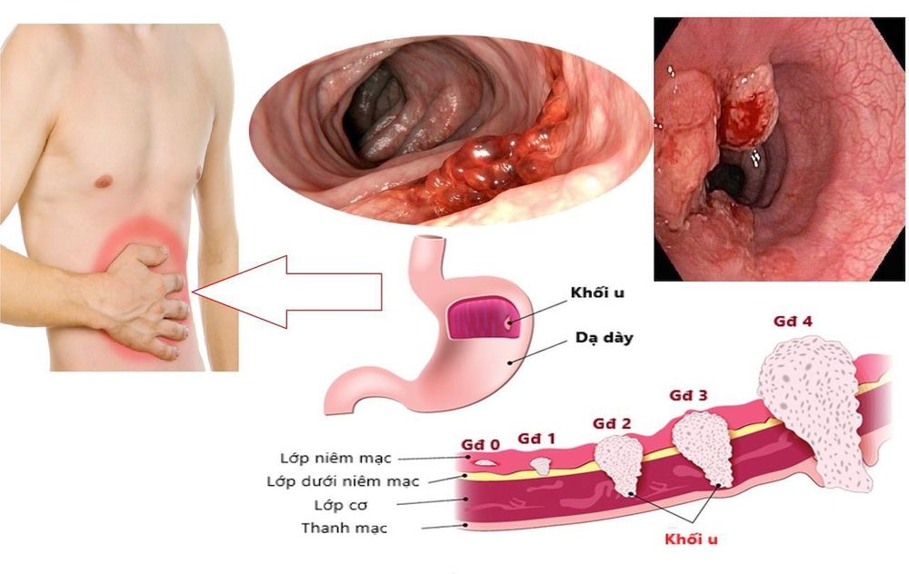 
Khám sức khỏe định kỳ phòng ngừa ung thư dạ dày
