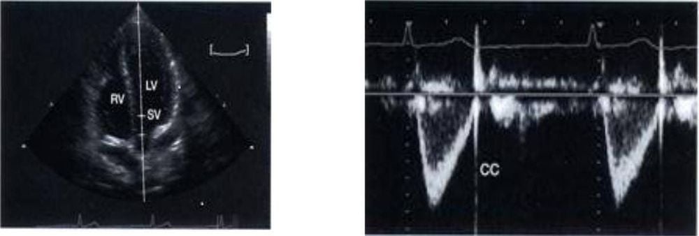 
Doppler xung qua dòng chảy van động mạch chủ
