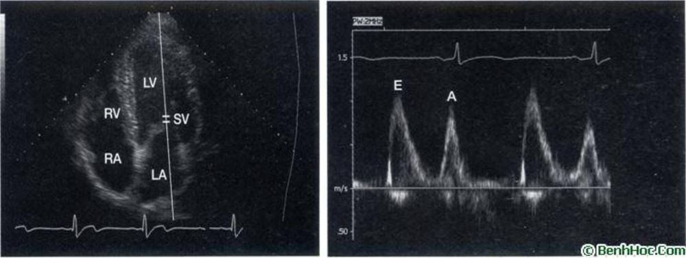 
Doppler xung qua dòng chảy van hai lá
