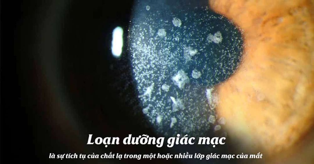 
Loạn dưỡng giác mạc
