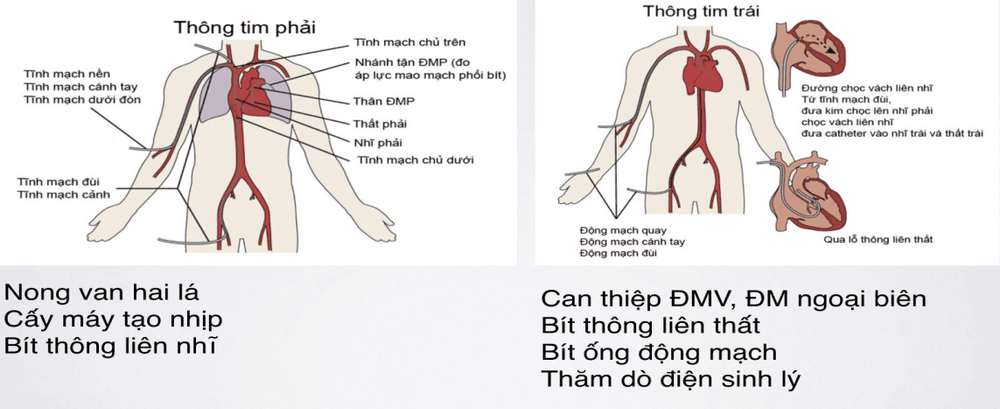 
Biến chứng tại vị trí chọc mạch máu
