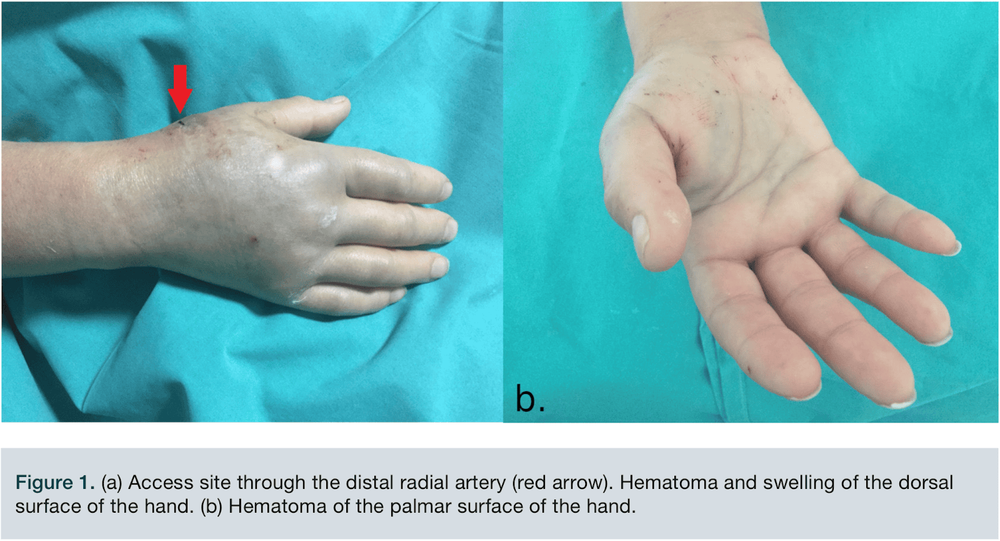 Hematoma at the puncture of a large blood vessel