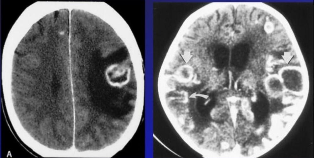 
Hình ảnh MRI lao hệ thần kinh trung ương
