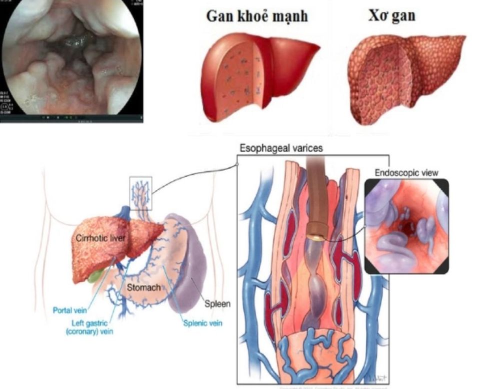 
Tăng áp lực trong long hệ tĩnh mạch cửa là nguyên nhân chủ yếu dây giãn vỡ tĩnh mạch ở thực quản
