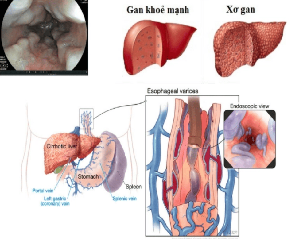 
Kỹ thuật tạo Shunt cửa chủ trong gan được áp dụng điều trị bệnh tăng áp tĩnh mạch cửa là điển hình
